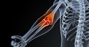 An Inflammatory Issue: The Effects of Bursitis