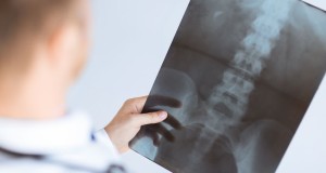 Spinal Fractures: Healing the Backbone of the Body