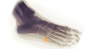 Treating Stress Fractures in the Foot