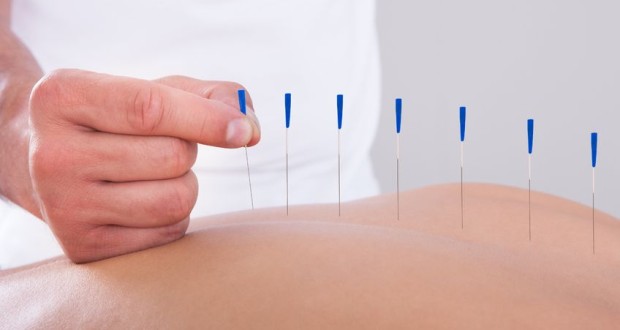 Taking a Hard Look at Acupuncture