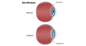 Cataracts: What Patients Should Know