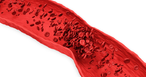 Deep Vein Thrombosis: Little Known but Lethal