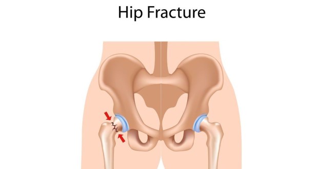 Hip Fractures: Another Concern for MS Patients?