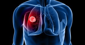 Making Tumors Glow: A New Way to Fight Lung Cancer?